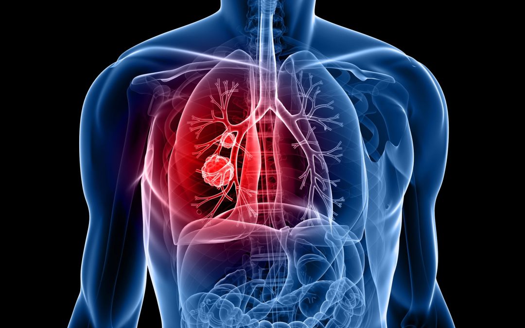 Persistent cough, hoarse voice, coughing up blood – are these symptoms of nose or lung cancer?