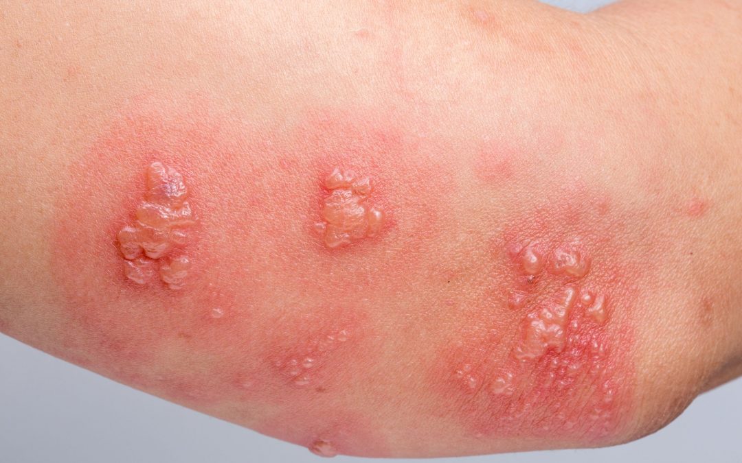 How do shingles develop and is it because of “heatiness”?