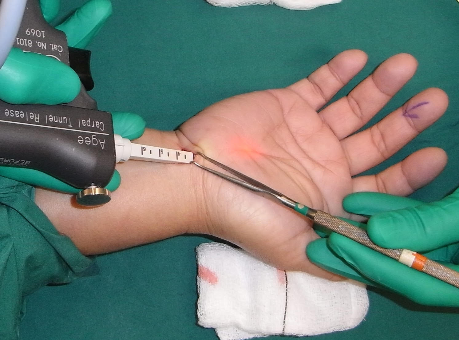 Keyhole surgery for hand numbness