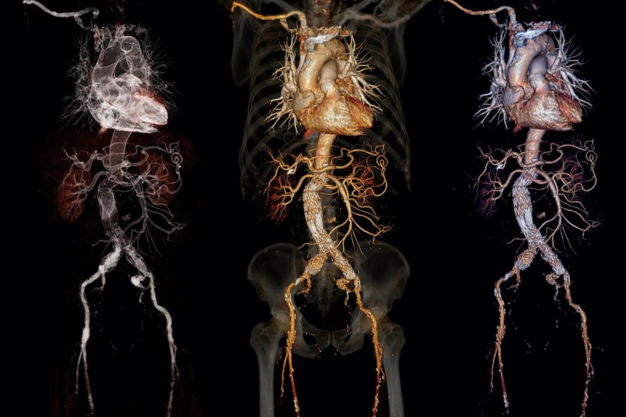 Asia MD_Abdominal aortic aneurysms – symptoms and risk factors
