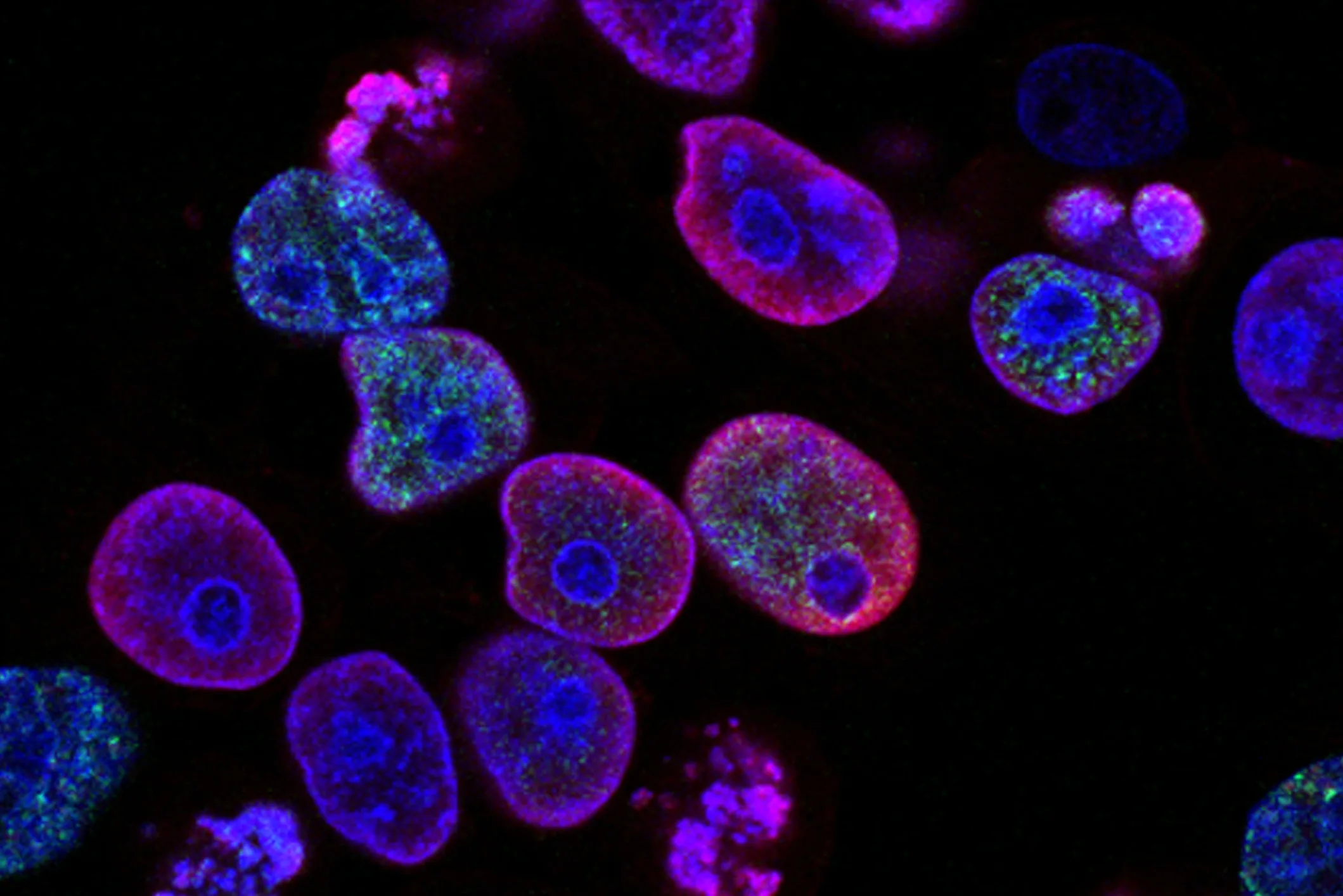 Asia MD Treatment and stages of colorectal cancer