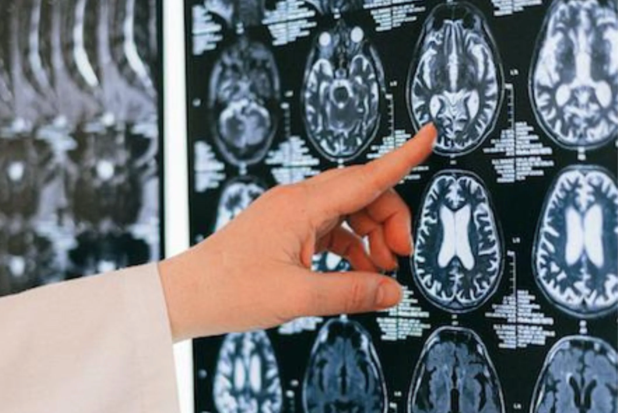 Asia MD_Treatments for Brain Tumours