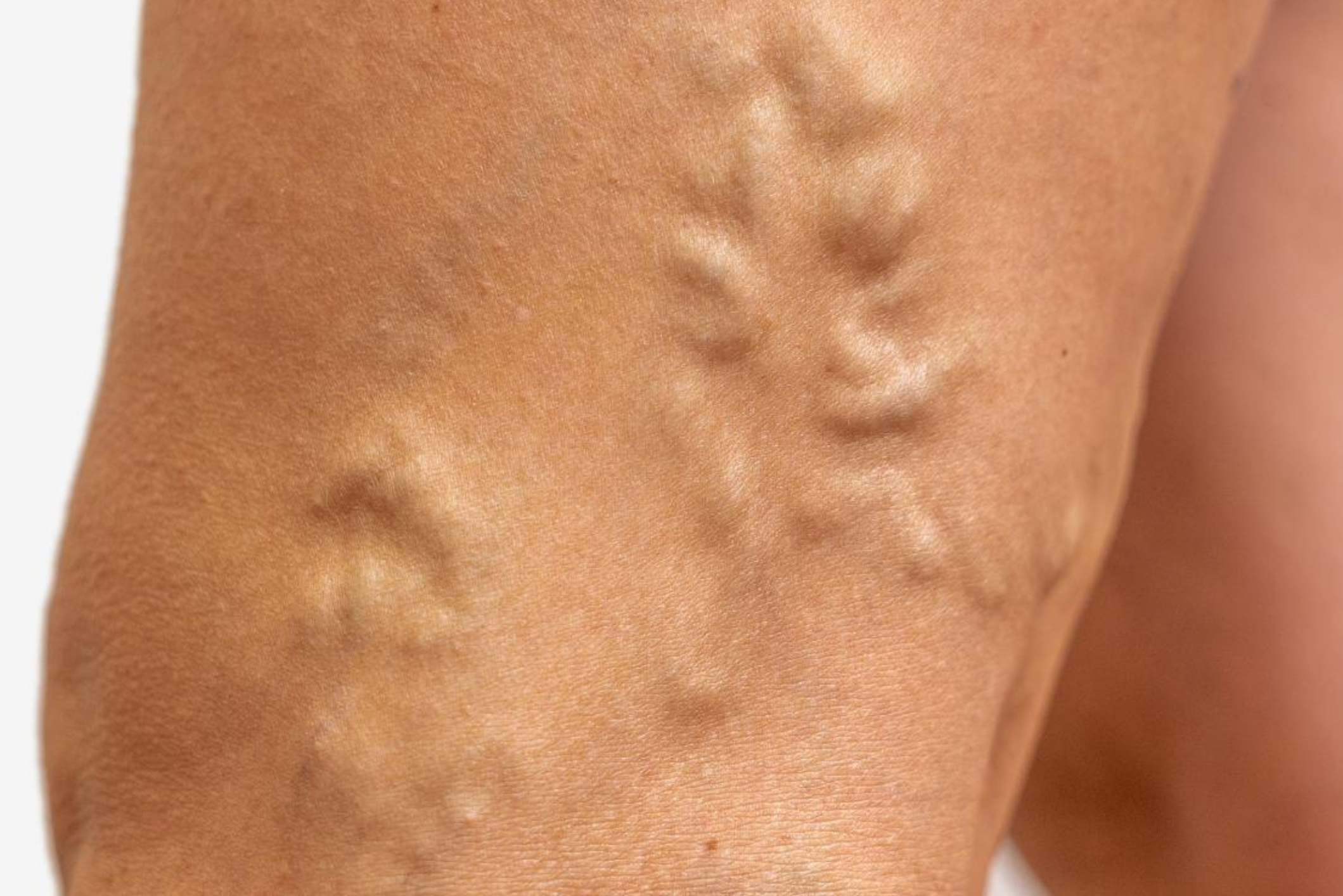 Varicose veins – causes and problems