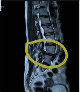 X-ray_Back Pain and Leg Symptoms in Older Adults