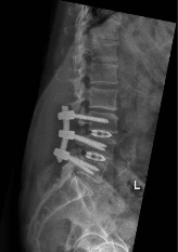 X-ray_Back Pain and Leg Symptoms in Older Adults