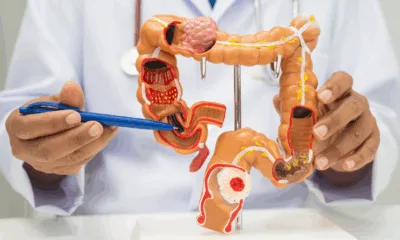 Asia MD_News_The Silent Revolution in Colorectal Cancer Care 1