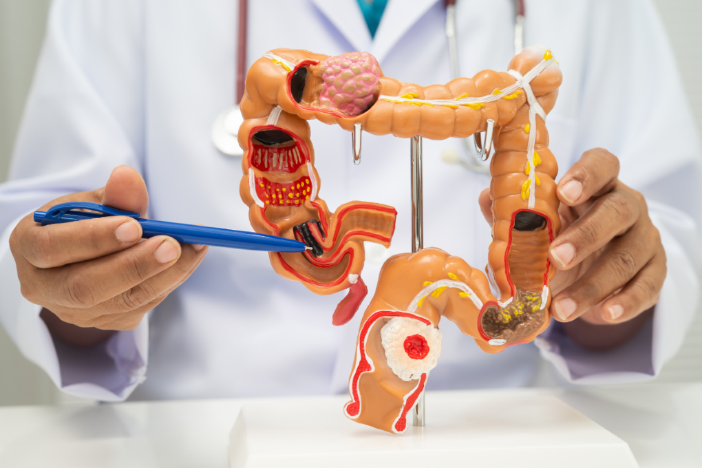 Asia MD_News_The Silent Revolution in Colorectal Cancer Care 1